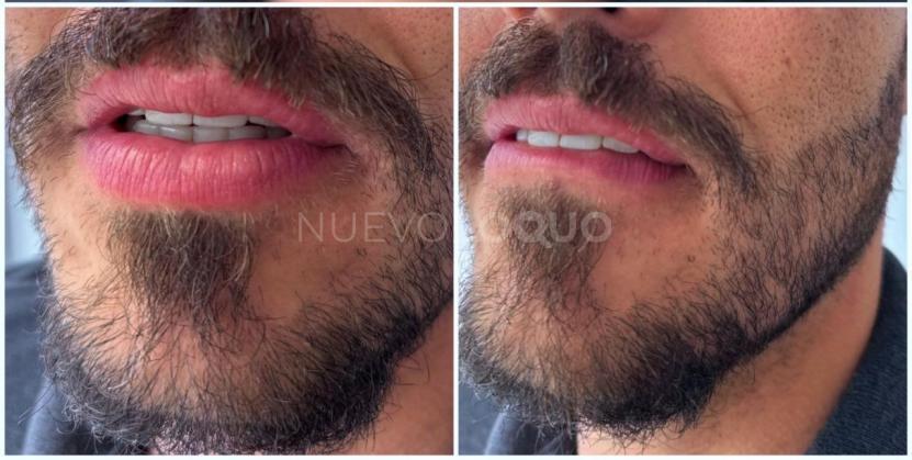 NuevoLoquo3